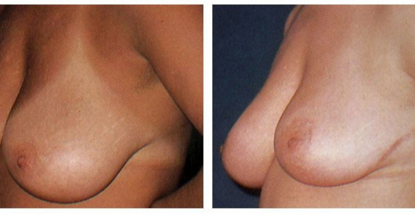 001-002-breast-lift