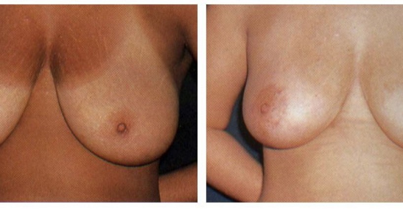 001-breast-lift